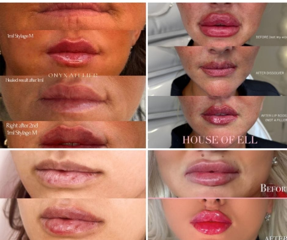 before and after lip fillers 
