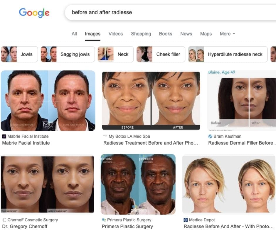 before and after radiesse image search