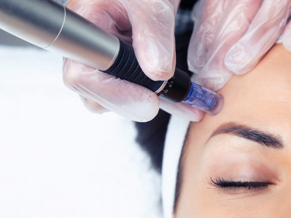 marketing aesthetics treatments for brides
