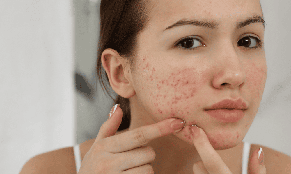 acne awareness month
