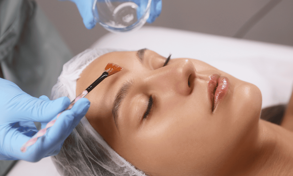 chemical peels for acne